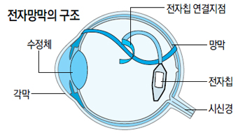 [뉴스 브리핑]시각장애인, 전자망막으로 눈이 ‘번쩍’