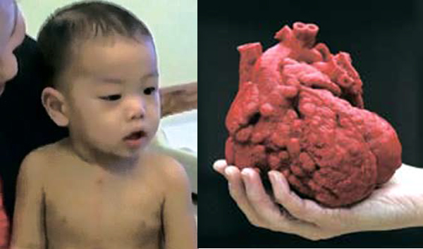 [뉴스 브리핑]‘3D 프린터’ 어린 생명 살렸다… 심장수술 도움